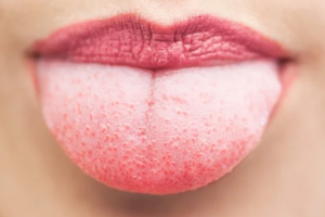 Why Do I Have a White Tongue? Causes and Treatment