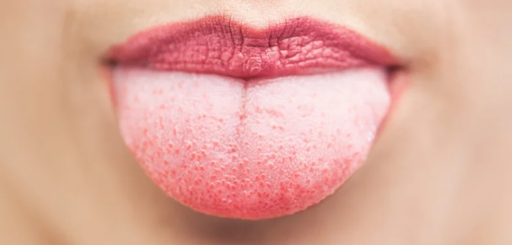 causes of white tongue