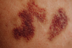 What Is a Hematoma and What Types Are There?