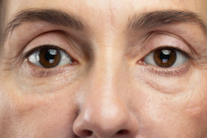 Under Eye Bags: Why They Appear and How to Get Rid of Them Naturally